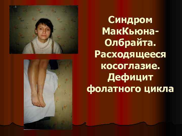 Синдром Мак. Кьюна. Олбрайта. Расходящееся косоглазие. Дефицит фолатного цикла 