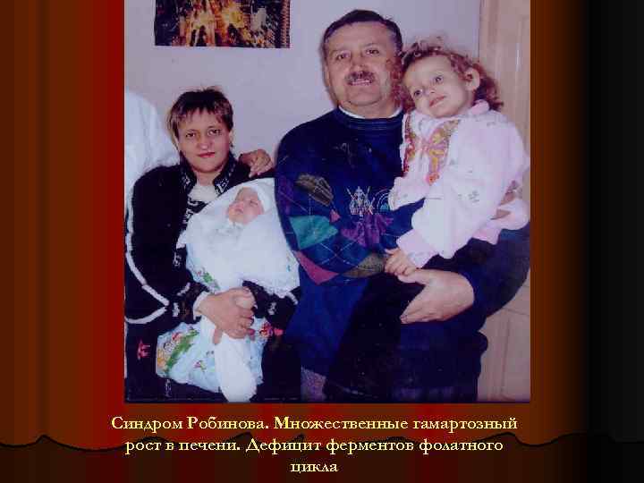 Синдром Робинова. Множественные гамартозный рост в печени. Дефицит ферментов фолатного цикла 