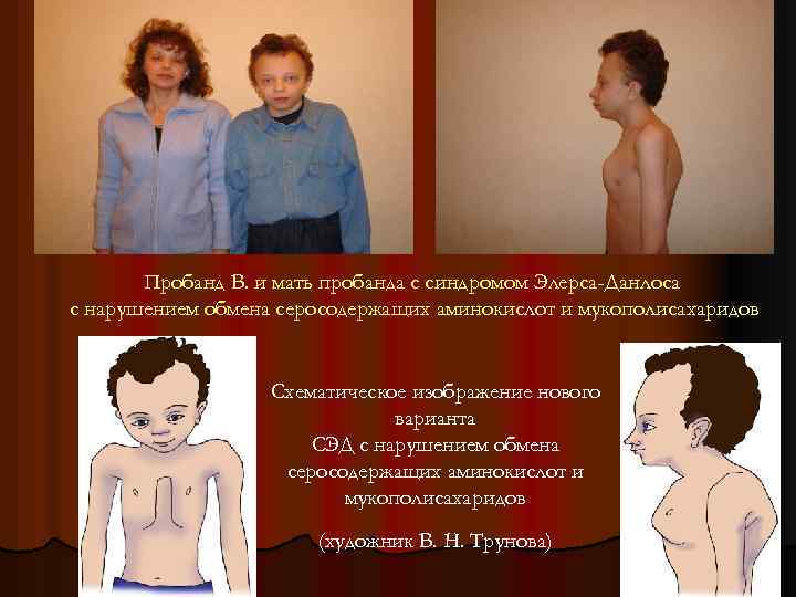 Пробанд В. и мать пробанда с синдромом Элерса-Данлоса с нарушением обмена серосодержащих аминокислот и
