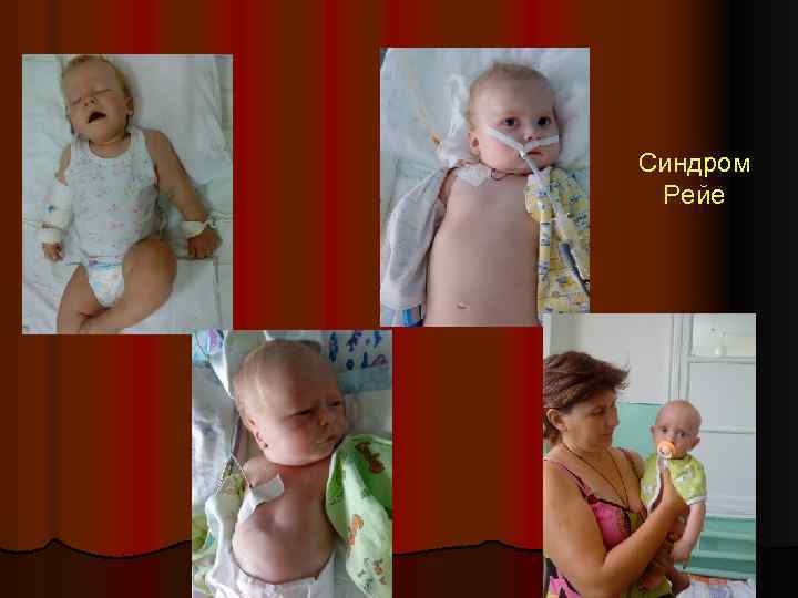 Синдром Рейе 