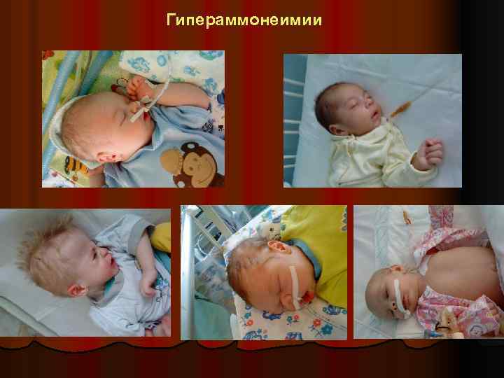 Гипераммонеимии 