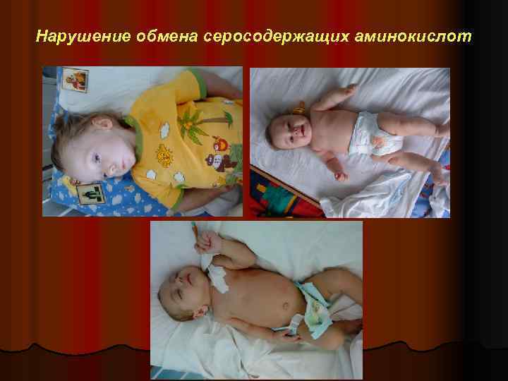 Нарушение обмена серосодержащих аминокислот 