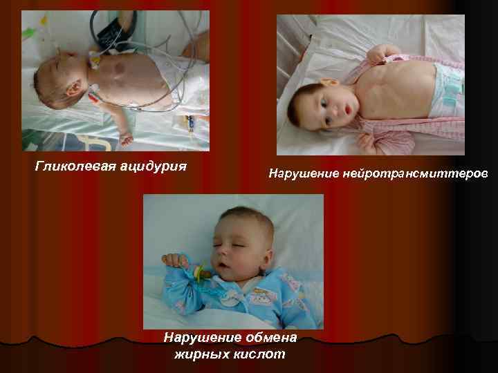 Гликолевая ацидурия Нарушение нейротрансмиттеров Нарушение обмена жирных кислот 