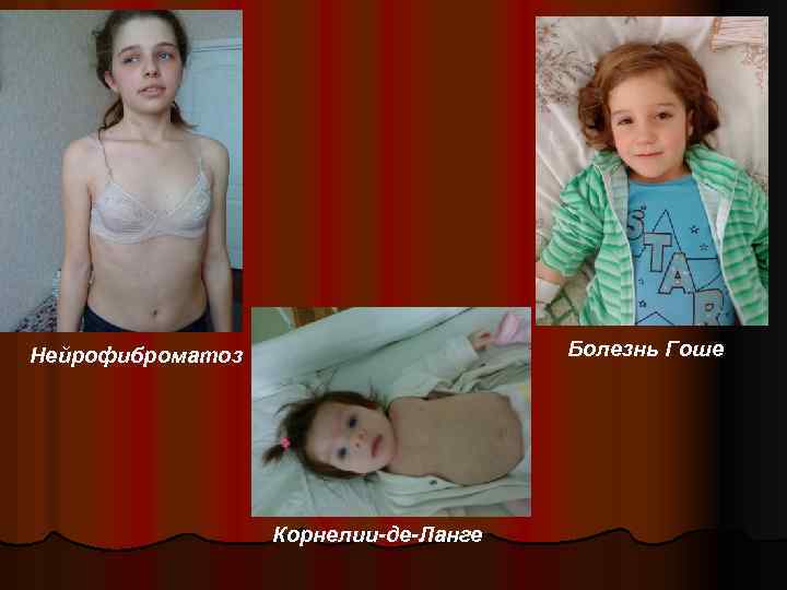 Болезнь Гоше Нейрофиброматоз Корнелии-де-Ланге 