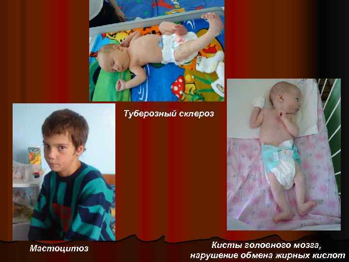 Туберозный склероз Мастоцитоз Кисты головного мозга, нарушение обмена жирных кислот 