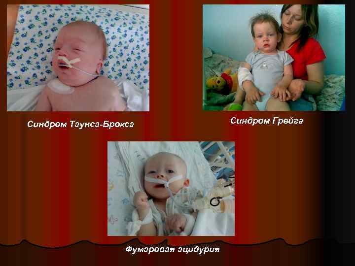 Синдром Таунса-Брокса Фумаровая ацидурия Синдром Грейга 