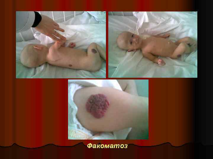 Факоматоз 