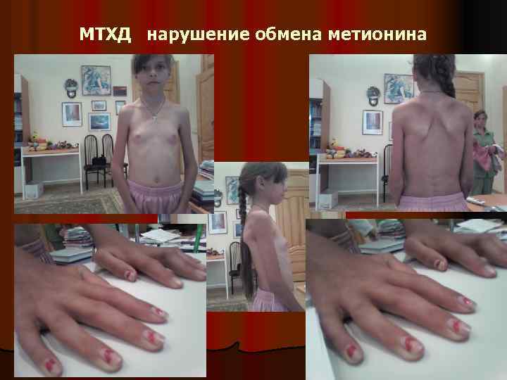 МТХД нарушение обмена метионина 