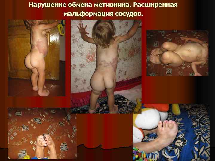 Нарушение обмена метионина. Расширенная мальформация сосудов. 
