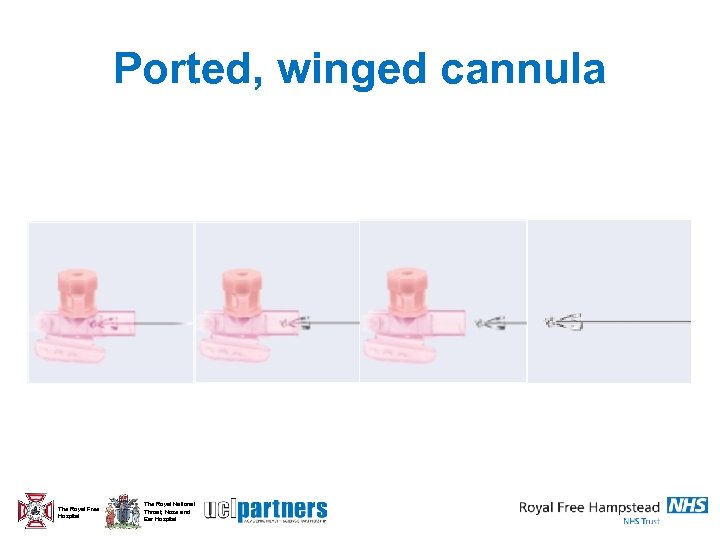 Ported, winged cannula The Royal Free Hospital The Royal National Throat, Nose and Ear