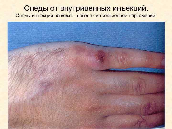 Следы от внутривенных инъекций. Следы инъекций на коже – признак инъекционной наркомании. 