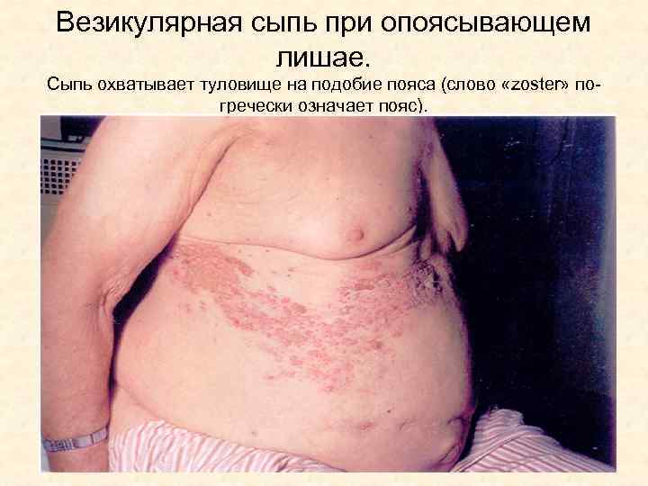 Везикулярная сыпь при опоясывающем лишае. Сыпь охватывает туловище на подобие пояса (слово «zoster» погречески