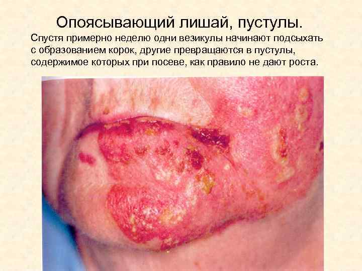 Опоясывающий лишай, пустулы. Спустя примерно неделю одни везикулы начинают подсыхать с образованием корок, другие