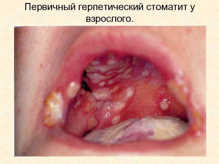 Первичный герпетический стоматит у взрослого. 