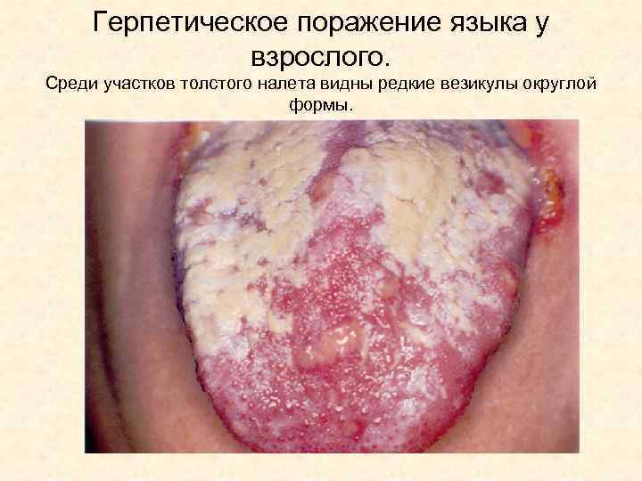 Герпетическое поражение языка у взрослого. Среди участков толстого налета видны редкие везикулы округлой формы.