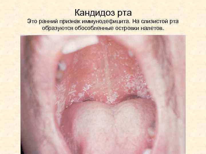 Кандидоз рта Это ранний признак иммунодефицита. На слизистой рта образуются обособленные островки налетов. 