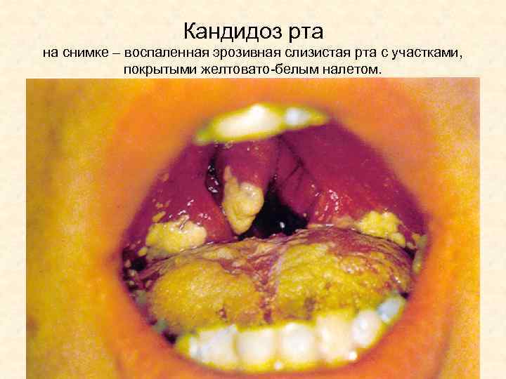 Кандидоз рта на снимке – воспаленная эрозивная слизистая рта с участками, покрытыми желтовато-белым налетом.