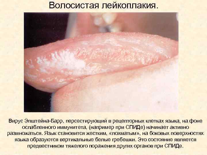 Волосистая лейкоплакия. Вирус Эпштейна-Барр, персестирующий в рецепторных клетках языка, на фоне ослабленного иммунитета, (например