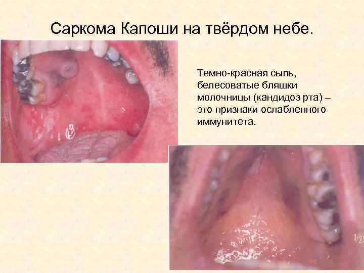 Саркома Капоши на твёрдом небе. Темно-красная сыпь, белесоватые бляшки молочницы (кандидоз рта) – это