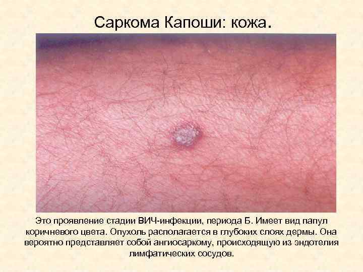 Саркома Капоши: кожа. Это проявление стадии ВИЧ-инфекции, периода Б. Имеет вид папул коричневого цвета.