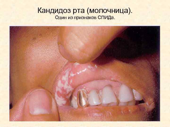 Кандидоз рта (молочница). Один из признаков СПИДа. 