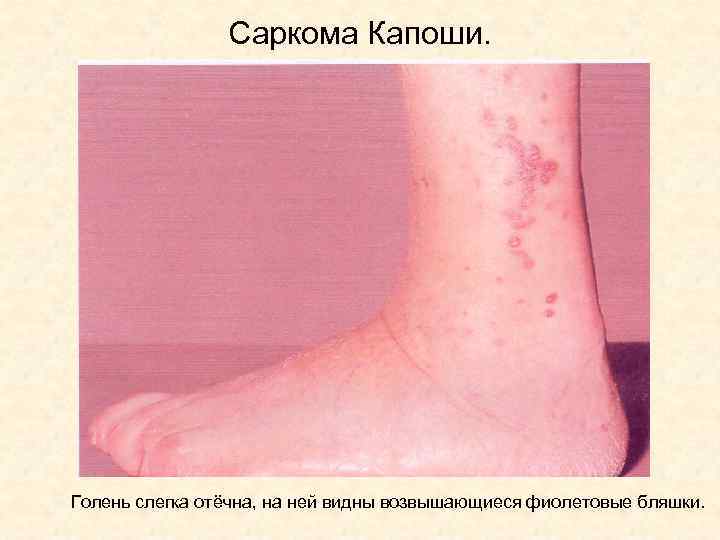 Саркома Капоши. Голень слегка отёчна, на ней видны возвышающиеся фиолетовые бляшки. 