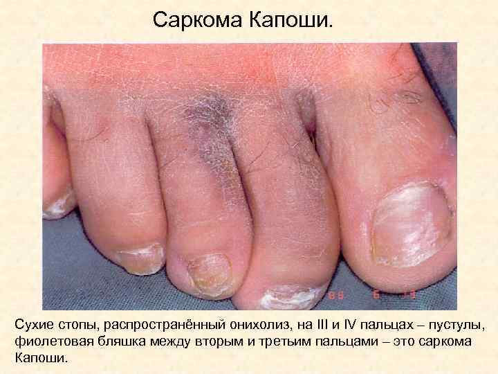 Саркома Капоши. Сухие стопы, распространённый онихолиз, на III и IV пальцах – пустулы, фиолетовая
