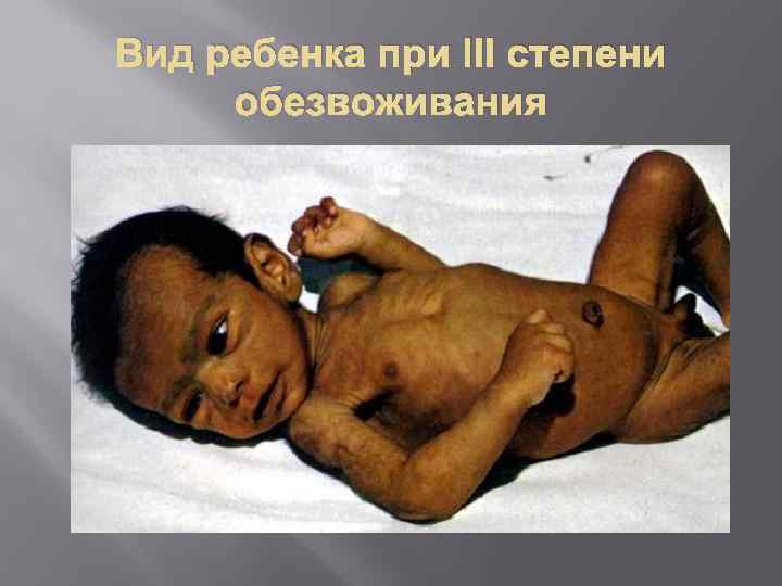 Вид ребенка при III степени обезвоживания 
