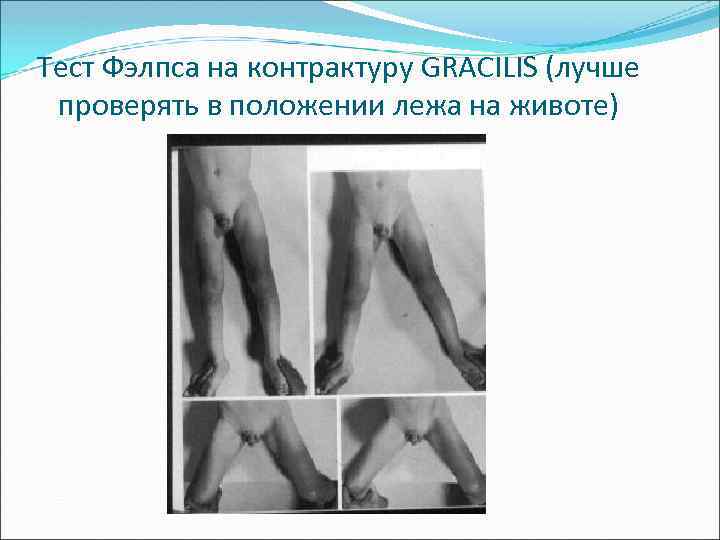 Тест Фэлпса на контрактуру GRACILIS (лучше проверять в положении лежа на животе) 