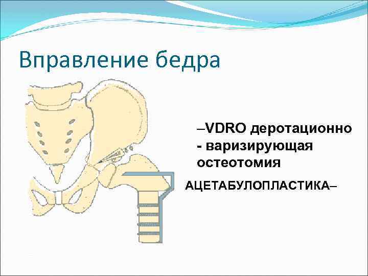 Вправление бедра –VDRO деротационно - варизирующая остеотомия АЦЕТАБУЛОПЛАСТИКА– 