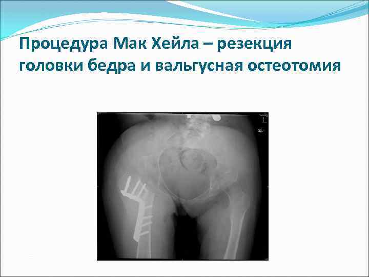 Процедура Мак Хейла – резекция головки бедра и вальгусная остеотомия 