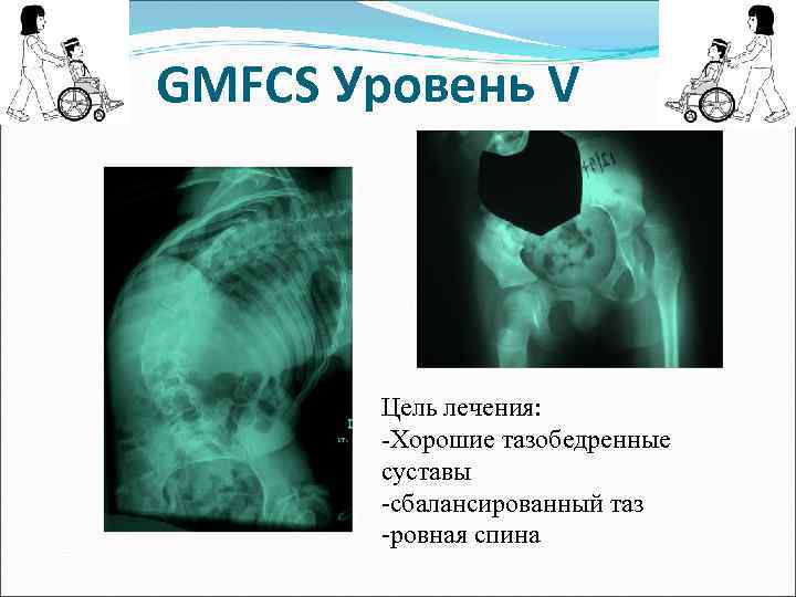 GMFCS Уровень V Цель лечения: -Хорошие тазобедренные суставы -сбалансированный таз -ровная спина 
