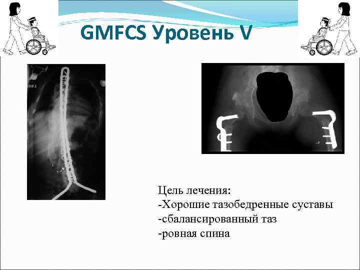 GMFCS Уровень V Цель лечения: -Хорошие тазобедренные суставы -сбалансированный таз -ровная спина 