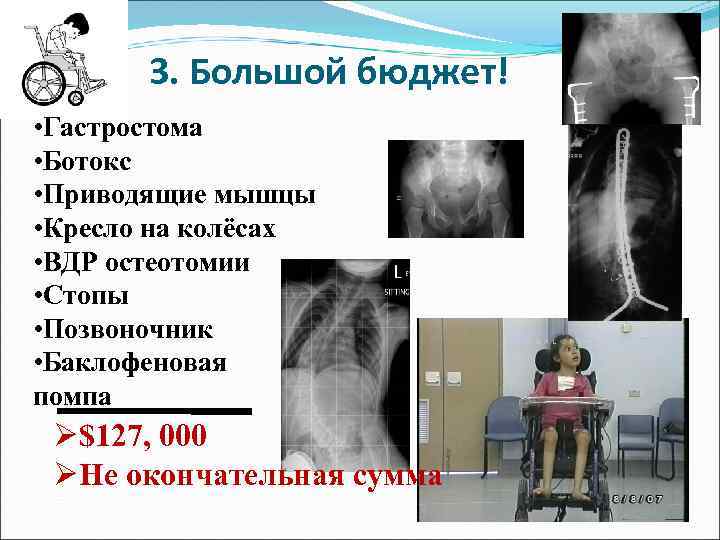 3. Большой бюджет! • Гастростома • Ботокс • Приводящие мышцы • Кресло на колёсах