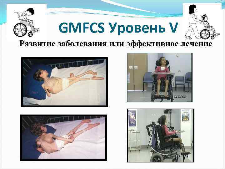 GMFCS Уровень V Развитие заболевания или эффективное лечение 