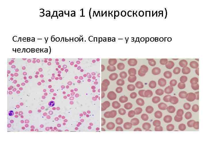 Задача 1 (микроскопия) Слева – у больной. Справа – у здорового человека) 