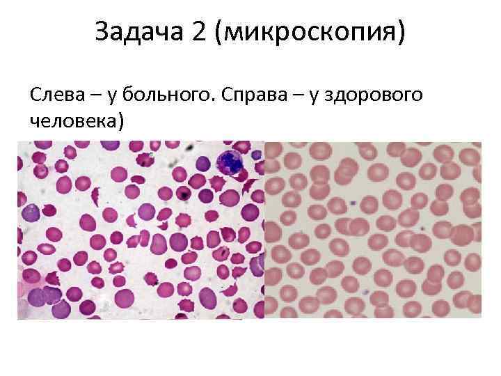 Задача 2 (микроскопия) Слева – у больного. Справа – у здорового человека) 