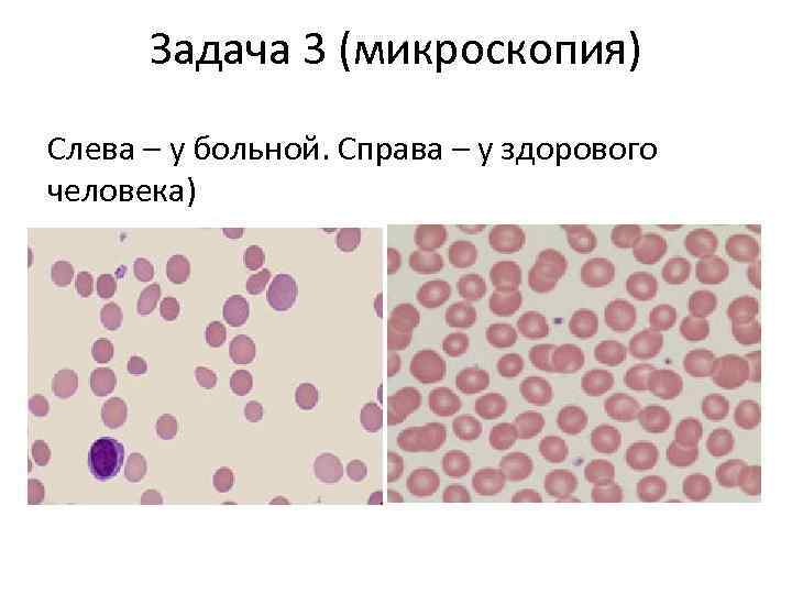 Задача 3 (микроскопия) Слева – у больной. Справа – у здорового человека) 