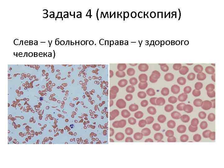 Задача 4 (микроскопия) Слева – у больного. Справа – у здорового человека) 