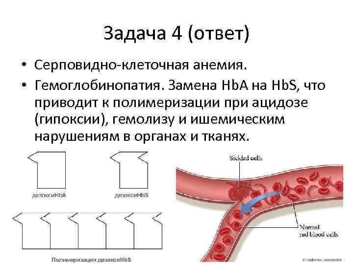 Задача 4 (ответ) • Серповидно-клеточная анемия. • Гемоглобинопатия. Замена Hb. A на Hb. S,