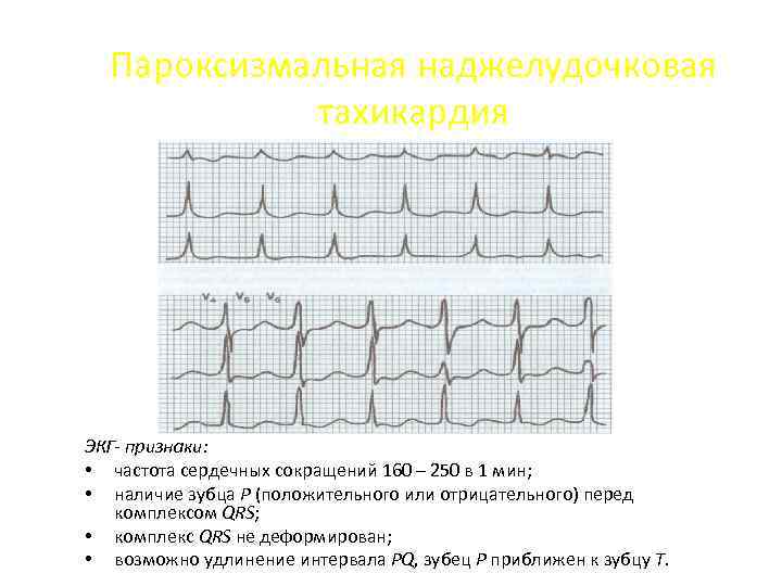 Пароксизмальная наджелудочковая тахикардия ЭКГ- признаки: • частота сердечных сокращений 160 – 250 в 1