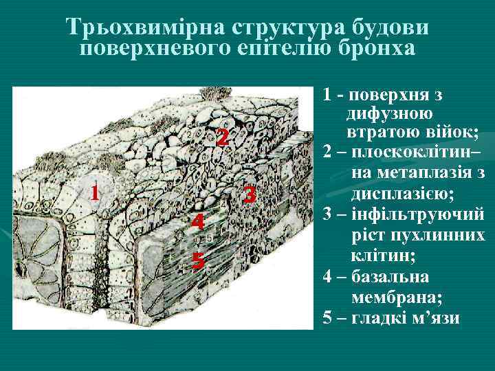 Трьохвимірна структура будови поверхневого епітелію бронха 2 1 3 4 5 1 - поверхня