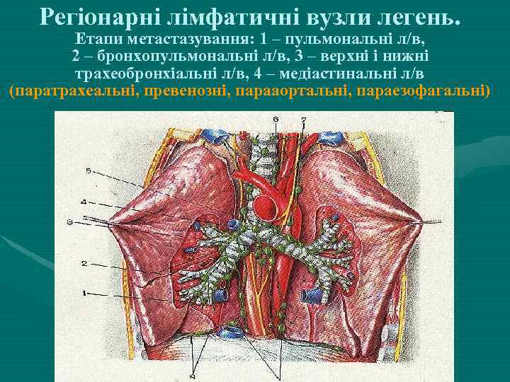 Регіонарні лімфатичні вузли легень. Етапи метастазування: 1 – пульмональні л/в, 2 – бронхопульмональні л/в,