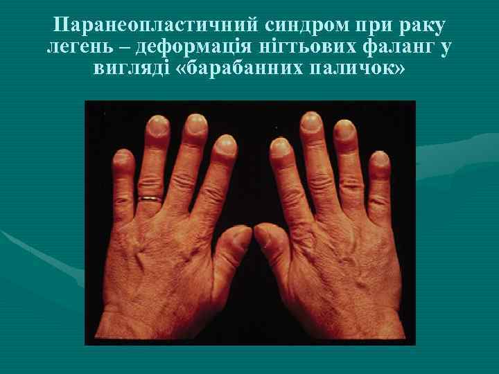 Паранеопластичний синдром при раку легень – деформація нігтьових фаланг у вигляді «барабанних паличок» 