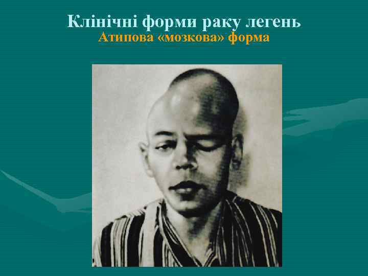 Клінічні форми раку легень Атипова «мозкова» форма 