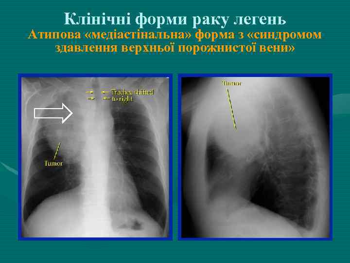 Клінічні форми раку легень Атипова «медіастінальна» форма з «синдромом здавлення верхньої порожнистої вени» 