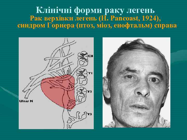 Клінічні форми раку легень Рак верхівки легень (H. Pancoast, 1924), синдром Горнера (птоз, міоз,