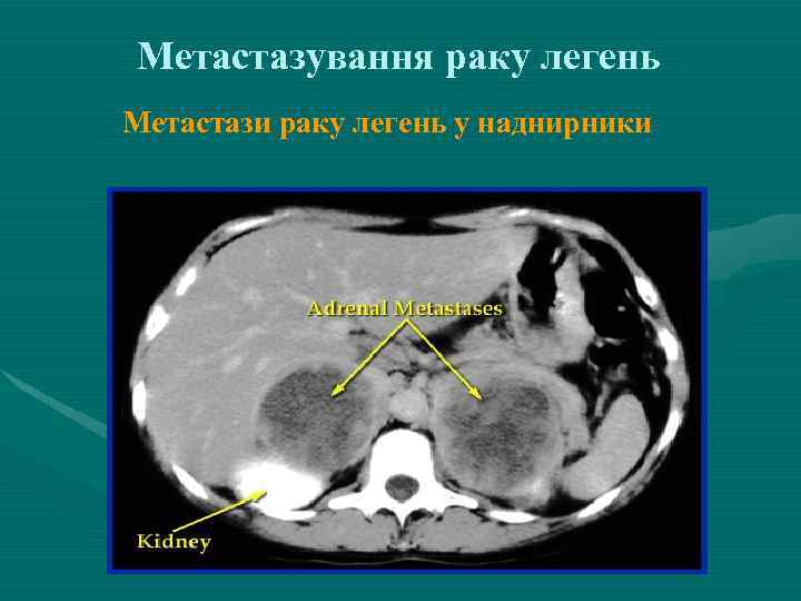 Метастазування раку легень Метастази раку легень у наднирники 