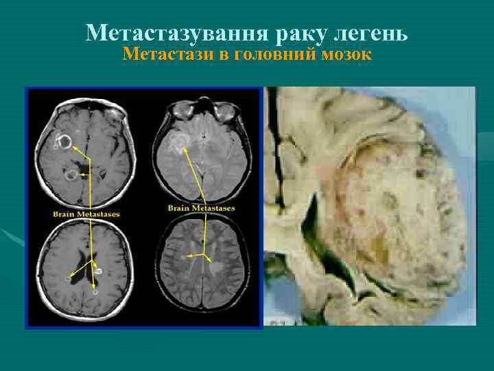 Метастазування раку легень Метастази в головний мозок 