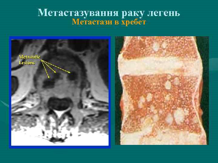 Метастазування раку легень Метастази в хребет 